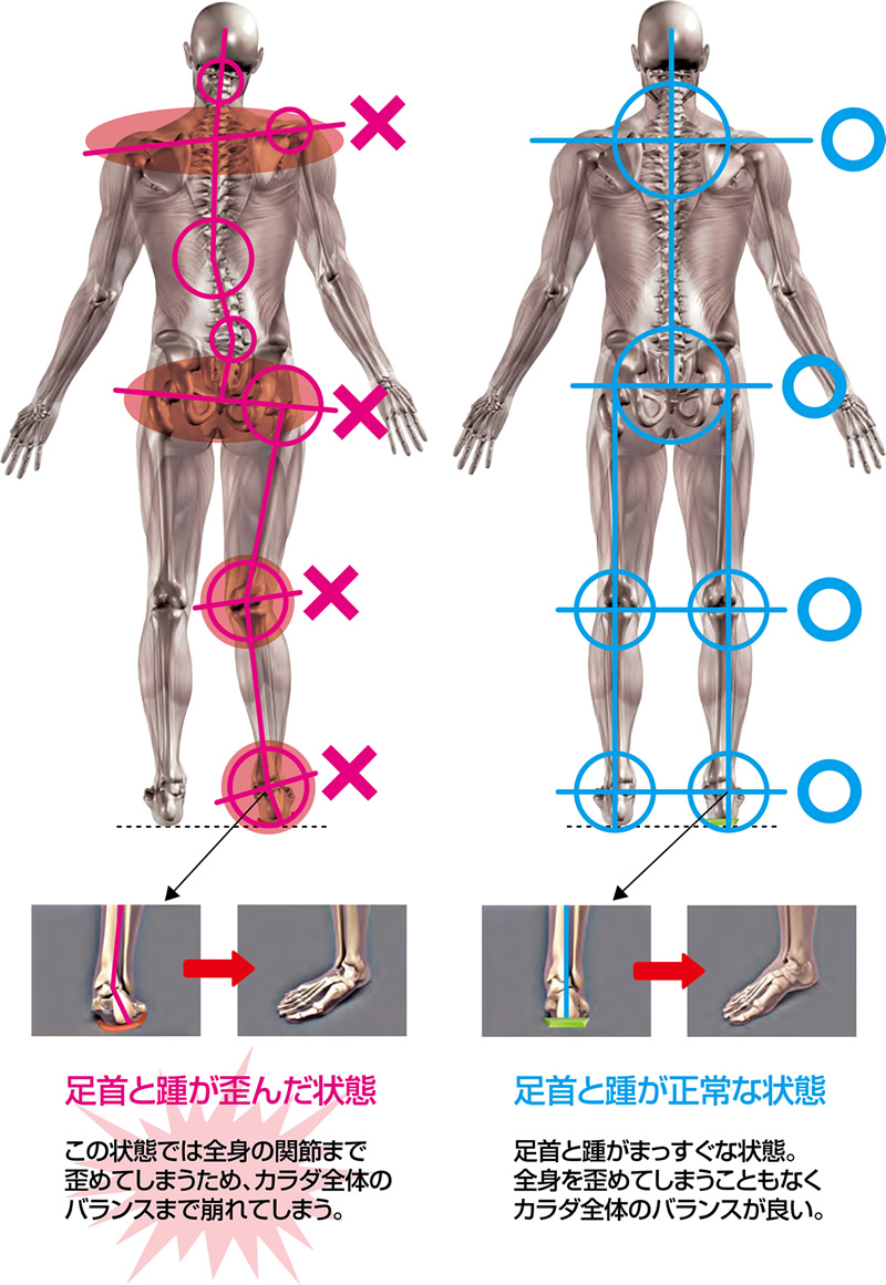 足首と踵が歪んだ状態と、正常な状態の比較