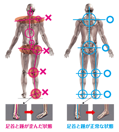 図：足首とカカトが正常な状態と歪んだ状態