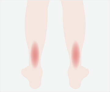 アキレス腱炎の症状