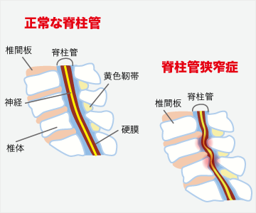 脊柱管狭窄症の症状