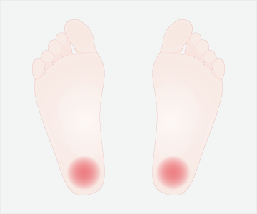 かかとの痛みや踵骨棘の症状
