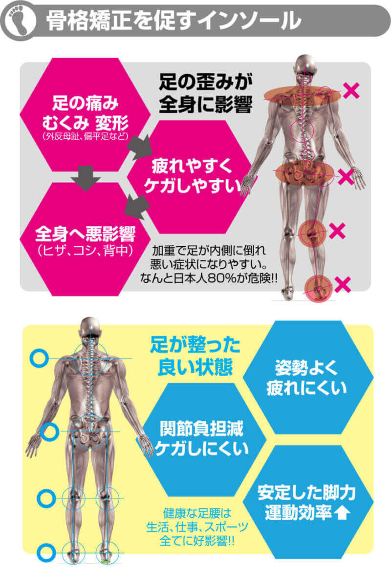 骨格矯正を促すインソール