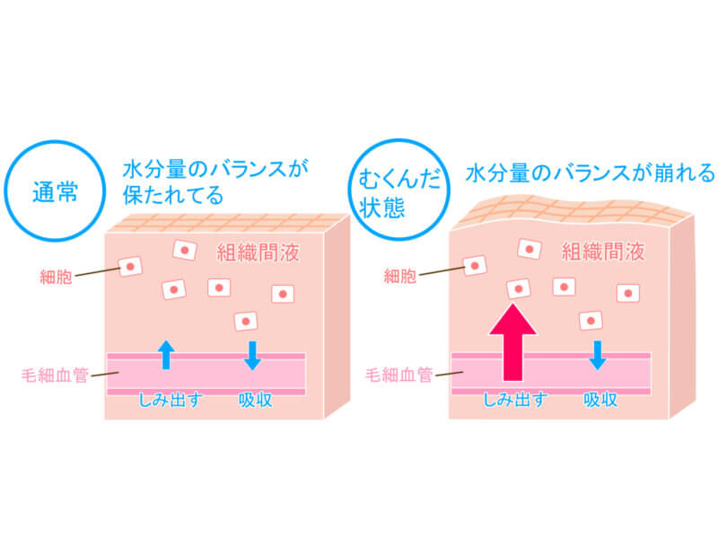 むくみの原因