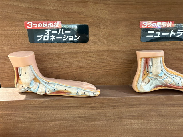 オーバープロネーション