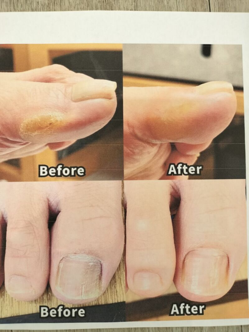 アスリートネイルbefore→after