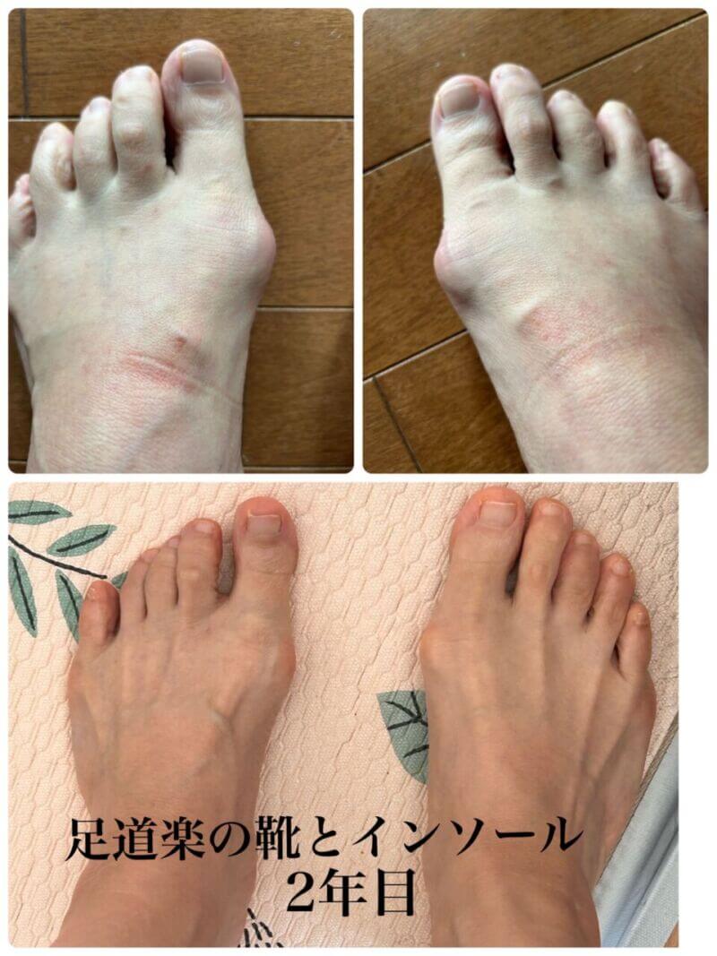 インソールで外反母趾の改善