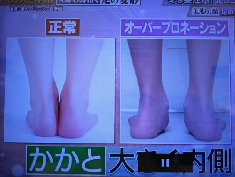 足の歪みで外反母趾になる！