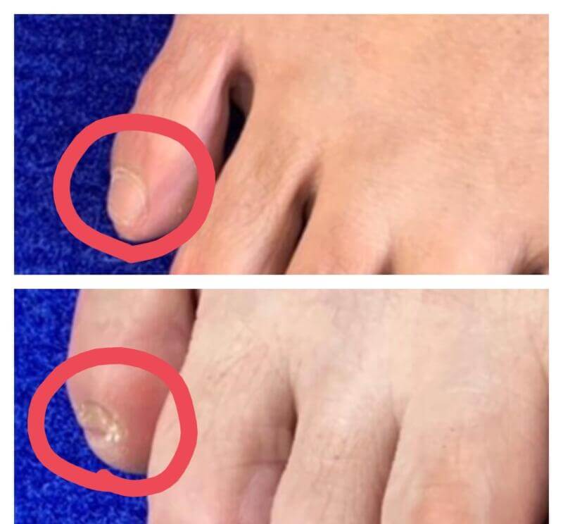 足の小指の爪が小さくなってしまう原因
