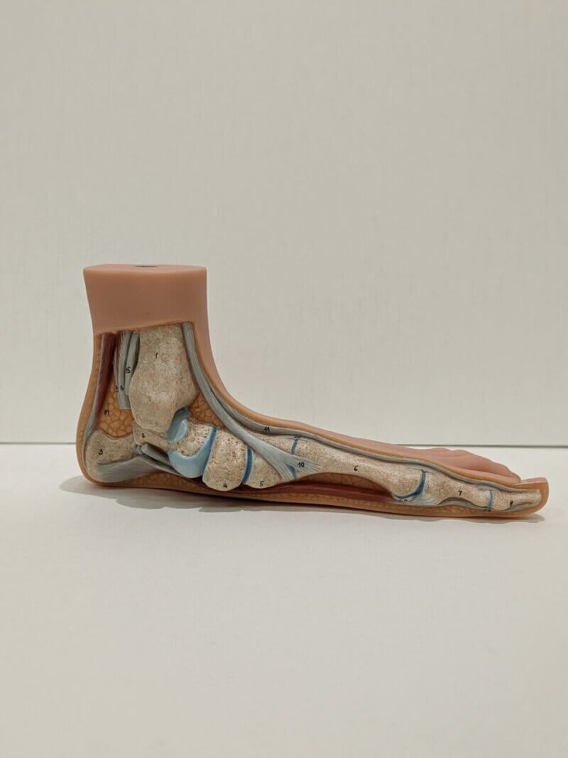 足の模型 オーバープロネーション