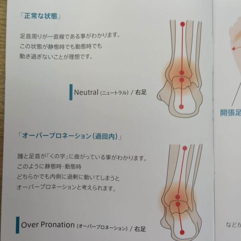 過回内 オーバープロネーション