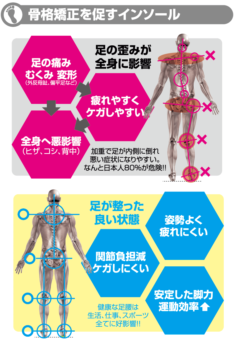 腰痛（脊柱管狭窄症・ヘルニア）の原因とインソール