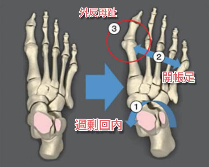 外反母趾・偏平足・開張足の原因はオーバープロネーション（過剰回内）